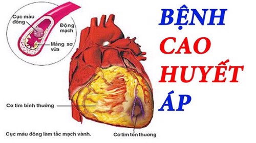 Tăng huyết áp dẫn đến bệnh gì? Giải pháp cải thiện từ thảo dược